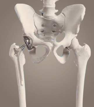 髖關(guān)節(jié)置換
